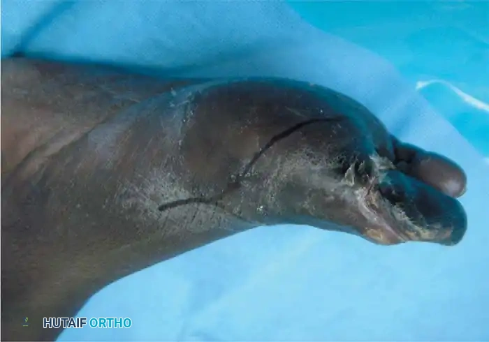 MTP joint disarticulation A