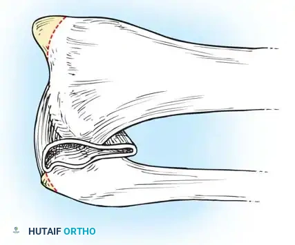 Amputations of the Upper Extremity Surgical Diagram