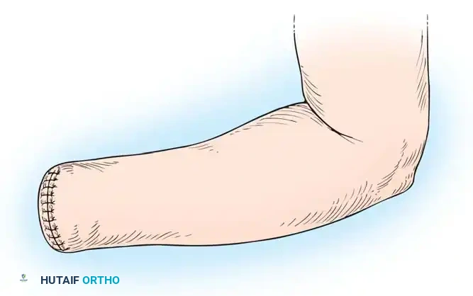 Amputations of the Upper Extremity Surgical Diagram