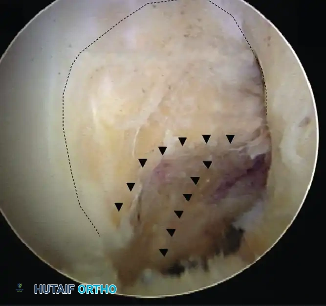 Upper 60% to 65% of notch wall