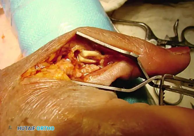 ANATOMICAL GRAFT RECONSTRUCTIONS Surgical Diagram