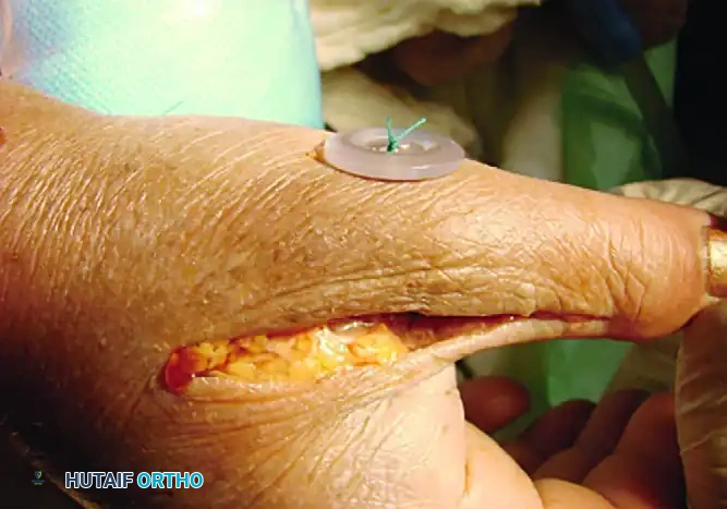 ANATOMICAL GRAFT RECONSTRUCTIONS Surgical Diagram