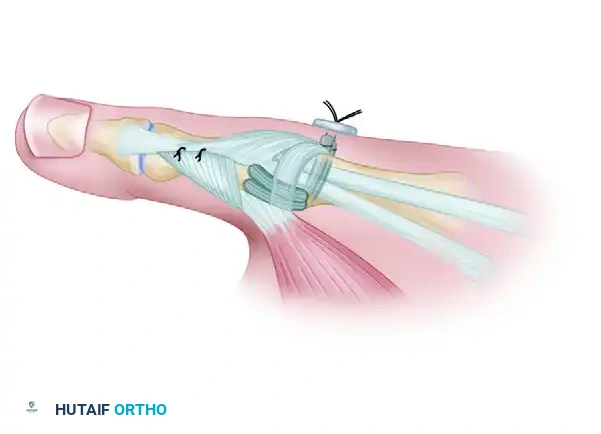 ANATOMICAL GRAFT RECONSTRUCTIONS Surgical Diagram