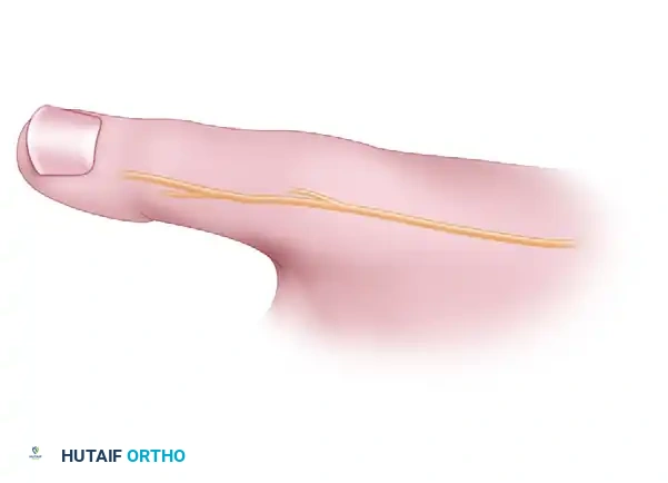 Anatomical Graft Reconstruction of the Thumb Ulnar Collateral Ligament