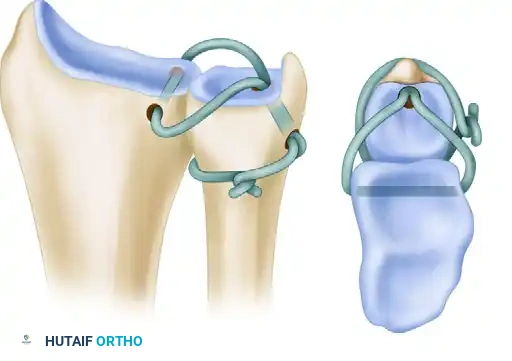 ANATOMICAL RECONSTRUCTION OF THE DISTAL RADIOULNAR LIGAMENTS Surgical Diagram