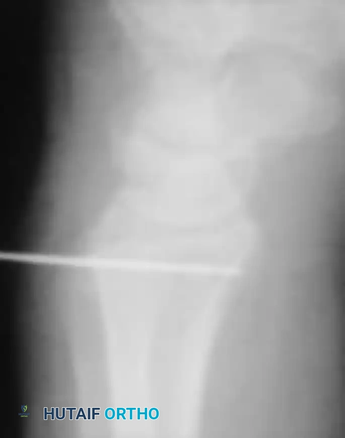 ANATOMICAL RECONSTRUCTION OF THE DISTAL RADIOULNAR LIGAMENTS Surgical Diagram