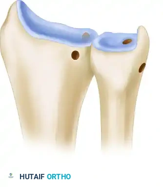 ANATOMICAL RECONSTRUCTION OF THE DISTAL RADIOULNAR LIGAMENTS Surgical Diagram
