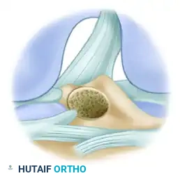 ANATOMICAL SINGLE-BUNDLE ENDOSCOPIC ANTERIOR CRUCIATE LIGAMENT RECONSTRUCTION USING BONE-PATELLAR TENDON-BONE GRAFT Surgical Diagram