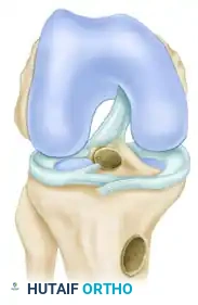 ANATOMICAL SINGLE-BUNDLE ENDOSCOPIC ANTERIOR CRUCIATE LIGAMENT RECONSTRUCTION USING BONE-PATELLAR TENDON-BONE GRAFT Surgical Diagram