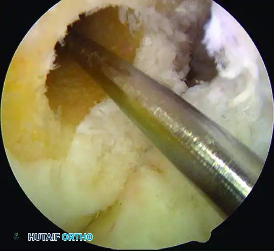 ANATOMICAL SINGLE-BUNDLE ENDOSCOPIC ANTERIOR CRUCIATE LIGAMENT RECONSTRUCTION USING BONE-PATELLAR TENDON-BONE GRAFT Surgical Diagram