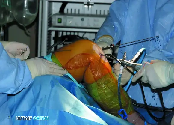 ANATOMICAL SINGLE-BUNDLE ENDOSCOPIC ANTERIOR CRUCIATE LIGAMENT RECONSTRUCTION USING BONE-PATELLAR TENDON-BONE GRAFT Surgical Diagram