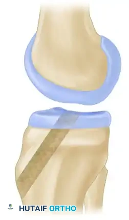 ANATOMICAL SINGLE-BUNDLE ENDOSCOPIC ANTERIOR CRUCIATE LIGAMENT RECONSTRUCTION USING BONE-PATELLAR TENDON-BONE GRAFT Surgical Diagram