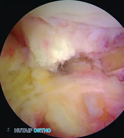 ANATOMICAL SINGLE-BUNDLE ENDOSCOPIC ANTERIOR CRUCIATE LIGAMENT RECONSTRUCTION USING BONE-PATELLAR TENDON-BONE GRAFT Surgical Diagram