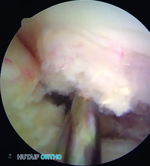 ANATOMICAL SINGLE-BUNDLE ENDOSCOPIC ANTERIOR CRUCIATE LIGAMENT RECONSTRUCTION USING BONE-PATELLAR TENDON-BONE GRAFT Surgical Diagram