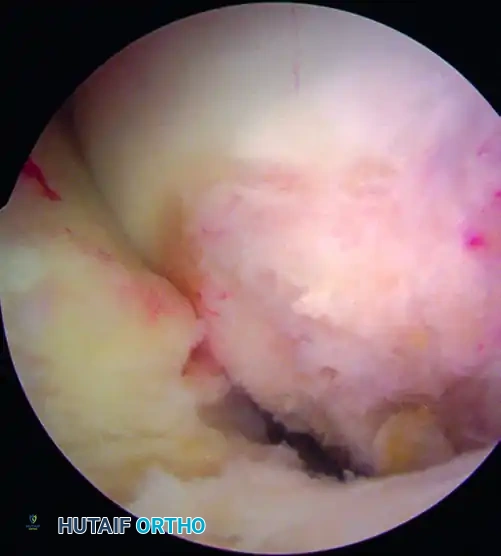 ANATOMICAL SINGLE-BUNDLE ENDOSCOPIC ANTERIOR CRUCIATE LIGAMENT RECONSTRUCTION USING BONE-PATELLAR TENDON-BONE GRAFT Surgical Diagram
