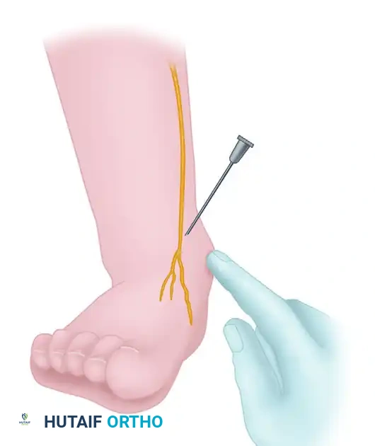 Sural Nerve Block