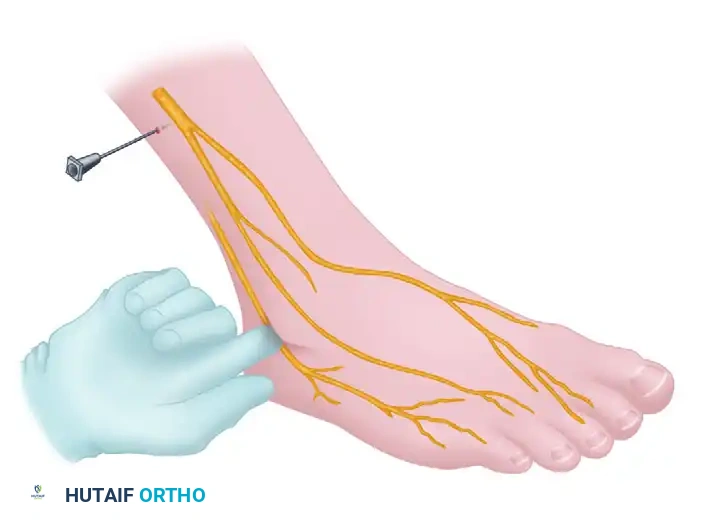 Deep Peroneal Nerve Block - Primary