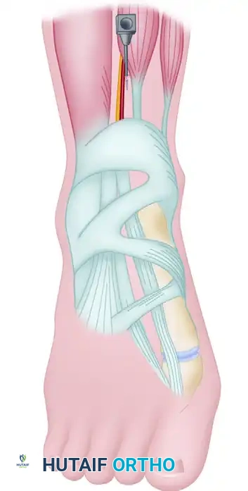 Deep Peroneal Nerve Block - Alternative