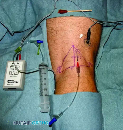 Popliteal Nerve Stimulator Technique
