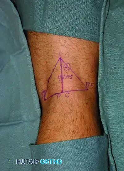 Popliteal Fossa Landmarks