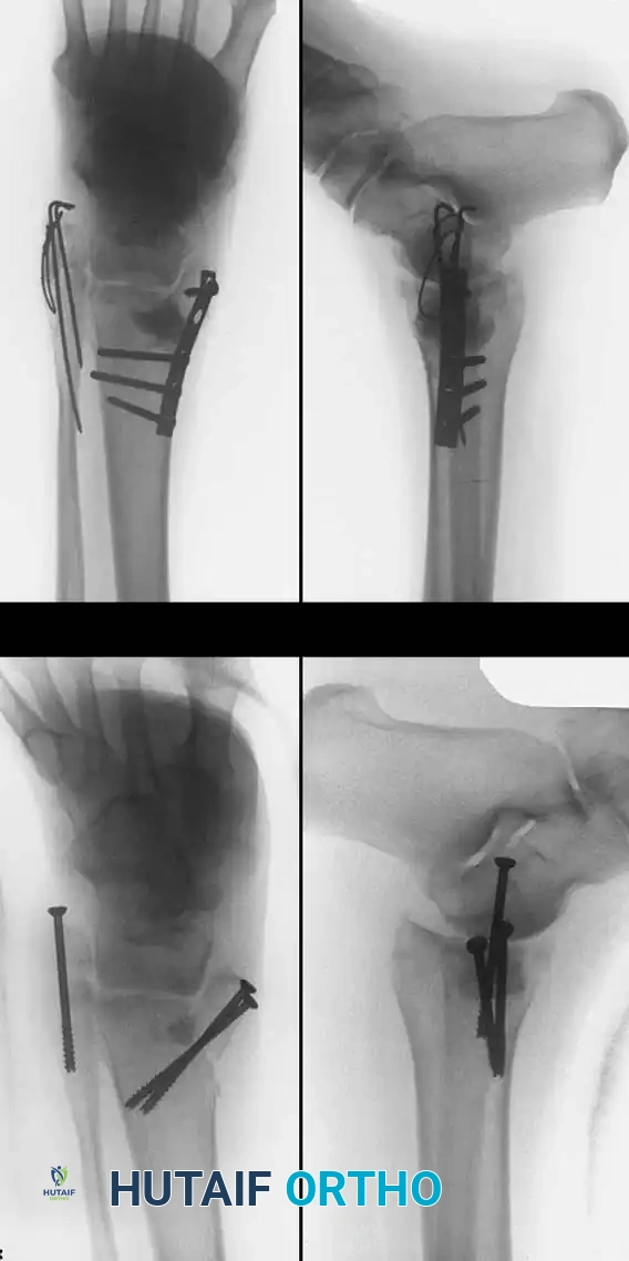 جراحة مراجعة لتثبيت كسر مزدوج في الكاحل باستخدام شريحة داعمة ورقعة عظمية