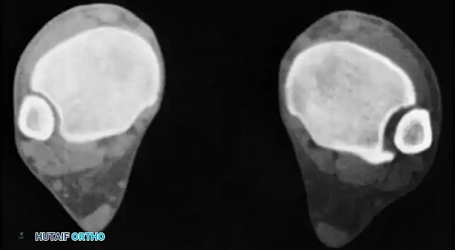 الدليل الشامل لعلاج التئام كسور الكاحل والقدم الخلفية بشكل خاطئ