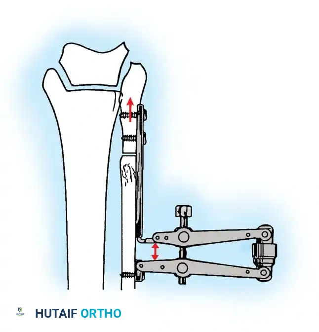 استخدام جهاز الشد للحصول على إطالة متحكم بها واستعادة شكل المفصل