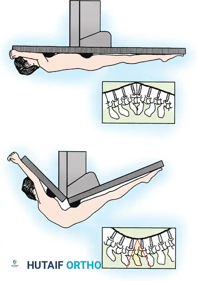 Patient positioning and hinge table mechanics for PSO