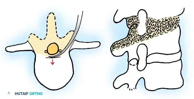 Eggshell osteotomy and vertebral column resection detail