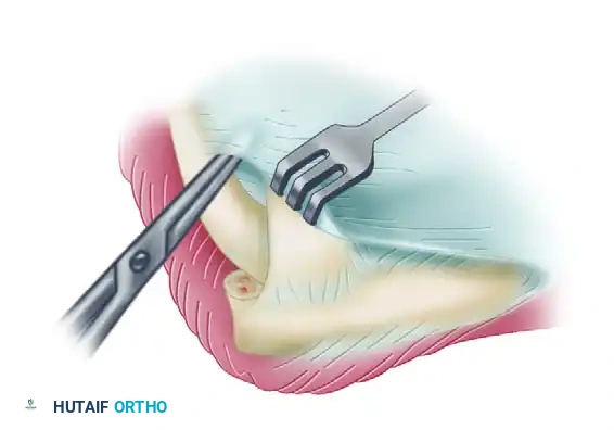 Extensor muscles are elevated to expose anterior part of capsule