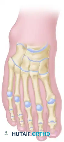 Japas V-Osteotomy Execution