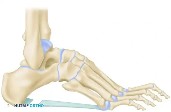 Japas V-Osteotomy Exposure