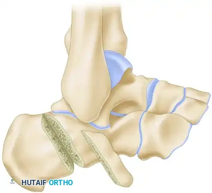 Dwyer Osteotomy Diagram A
