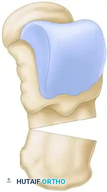 Dwyer Osteotomy Diagram B
