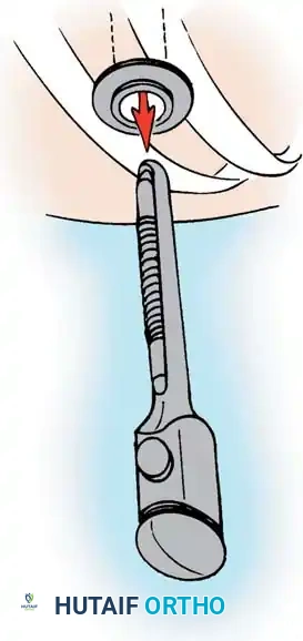 ANTERIOR THORACOPLASTY Surgical Diagram