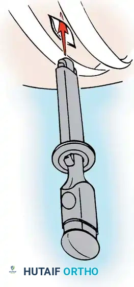 ANTERIOR THORACOPLASTY Surgical Diagram