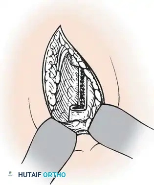 ANTERIOR THORACOPLASTY Surgical Diagram