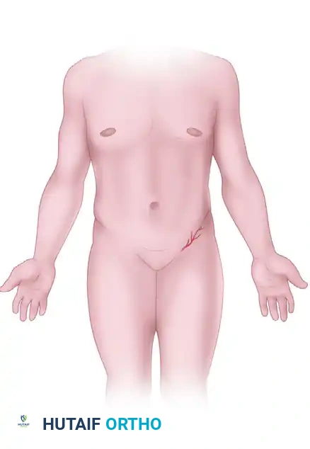 Posterior Interosseous & Abdominal Flaps: Surgical Technique