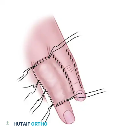 Cross Finger & Radial Forearm Flaps: Surgical Technique