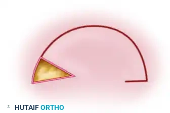 APPLYING SPLIT-THICKNESS GRAFTS Surgical Diagram