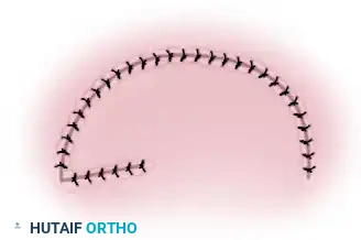 APPLYING SPLIT-THICKNESS GRAFTS Surgical Diagram