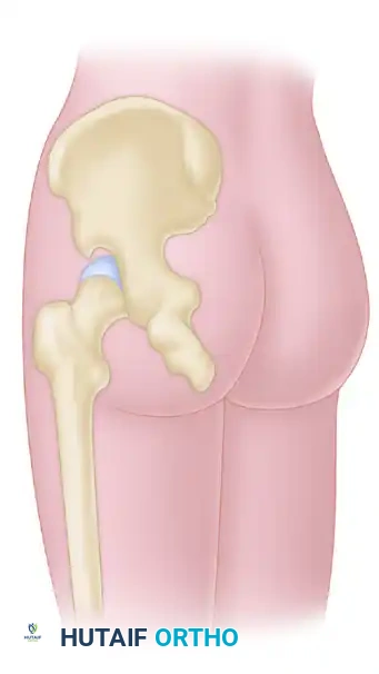 APPROACH TO THE SCIATIC NERVE Surgical Diagram