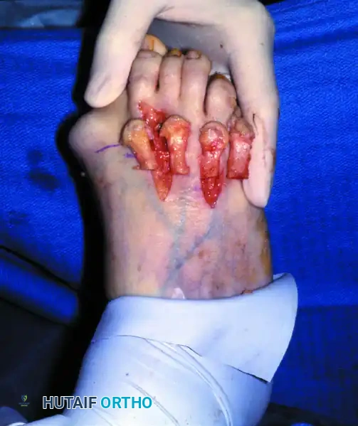 ARTHRODESIS OF THE FIRST METATARSOPHALANGEAL JOINT WITH RESECTION OF THE LESSER METATARSOPHALANGEAL JOINTS Surgical Diagram