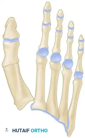 ARTHRODESIS OF THE FIRST METATARSOPHALANGEAL JOINT WITH RESECTION OF THE LESSER METATARSOPHALANGEAL JOINTS Surgical Diagram