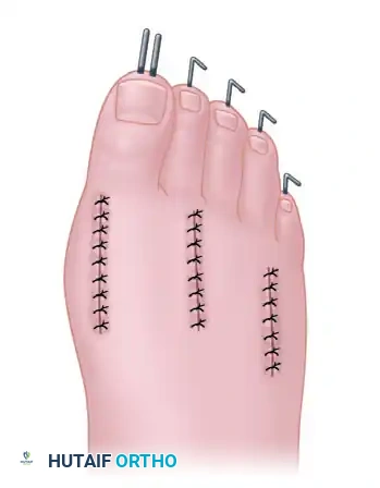 ARTHRODESIS OF THE FIRST METATARSOPHALANGEAL JOINT WITH RESECTION OF THE LESSER METATARSOPHALANGEAL JOINTS Surgical Diagram