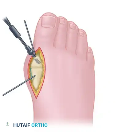 ARTHRODESIS OF THE FIRST METATARSOPHALANGEAL JOINT WITH RESECTION OF THE LESSER METATARSOPHALANGEAL JOINTS Surgical Diagram