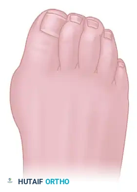 ARTHRODESIS OF THE FIRST METATARSOPHALANGEAL JOINT WITH RESECTION OF THE LESSER METATARSOPHALANGEAL JOINTS Surgical Diagram