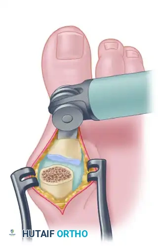 ARTHRODESIS OF THE FIRST METATARSOPHALANGEAL JOINT WITH RESECTION OF THE LESSER METATARSOPHALANGEAL JOINTS Surgical Diagram
