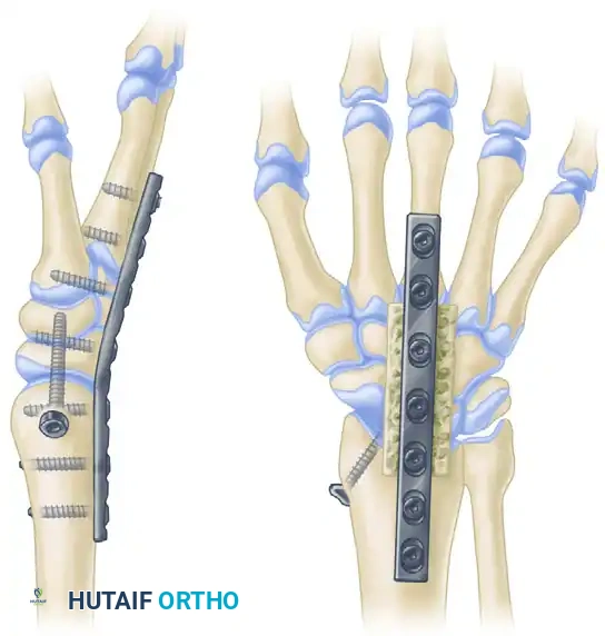 ARTHRODESIS OF THE WRIST Surgical Diagram
