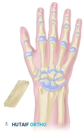 ARTHRODESIS OF THE WRIST Surgical Diagram